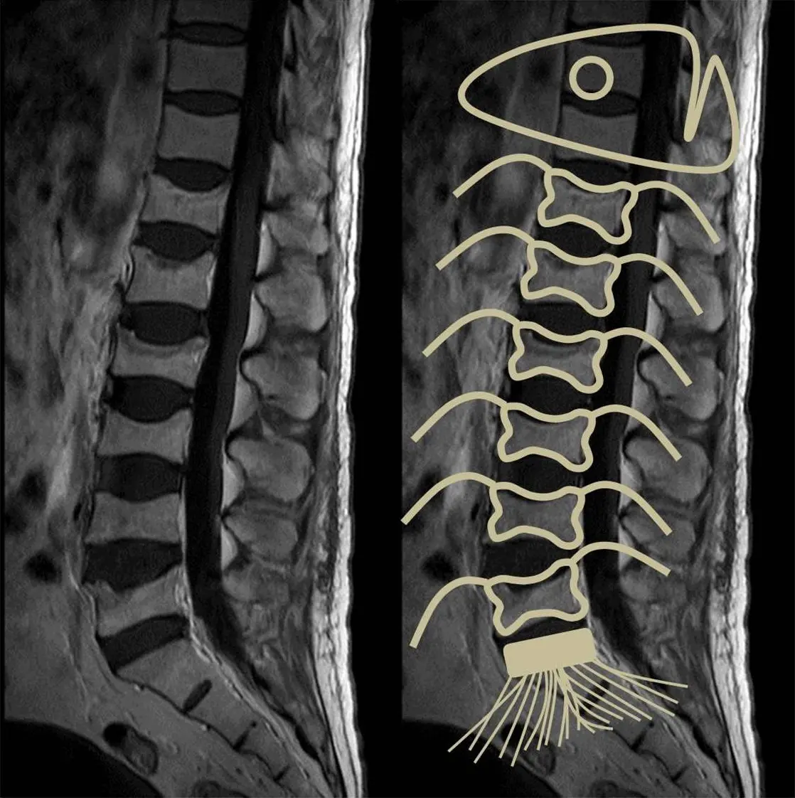 vertebra de pescado - Qué es espina vertebral